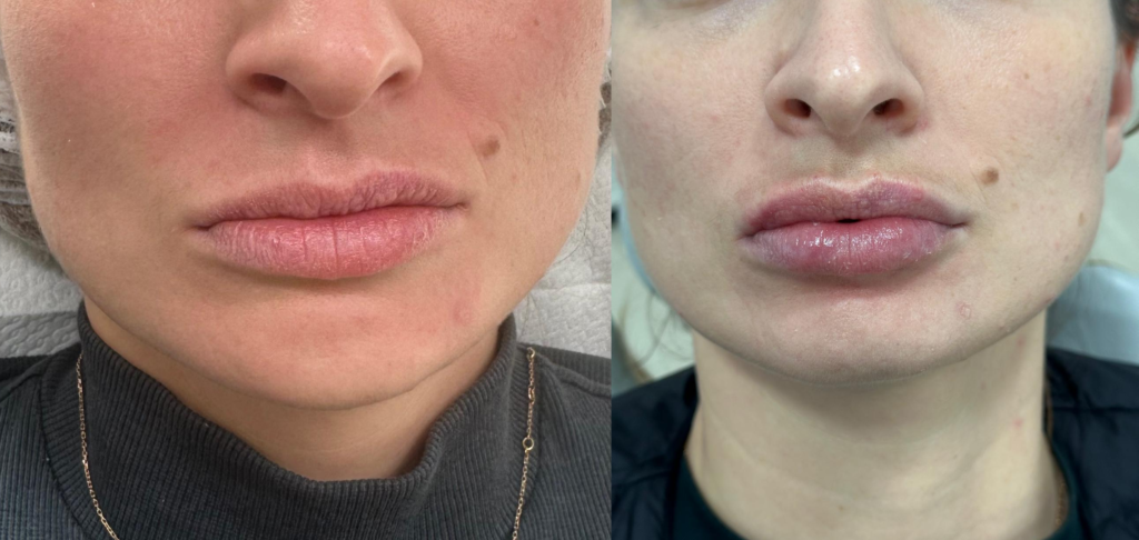antes e depois